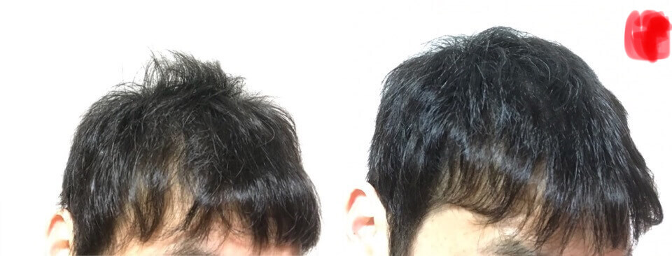イワシ缶生活育毛2か月の左側の髪の毛の変化