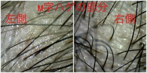 M字の所は毛が細い