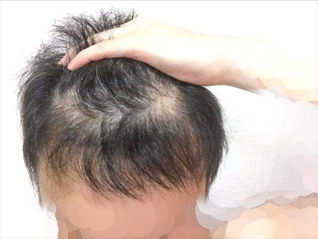 薄毛ハゲ頭